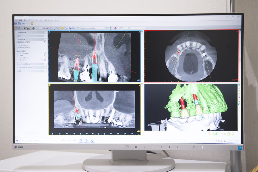 6：シムプラントガイドシステムと最新の歯科用CTを使用し、インプラントの位置や角度を正確に計算