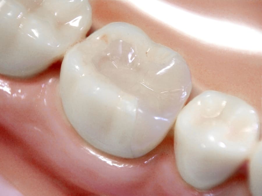 銀歯の悩みを解消！白い歯への変革の歴史