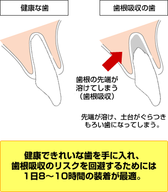 長時間の矯正は歯根吸収のリスク
