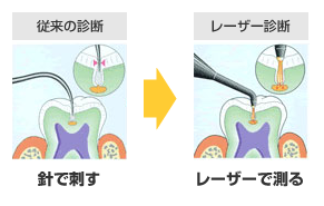 レーザー光を用いたう蝕検知機器