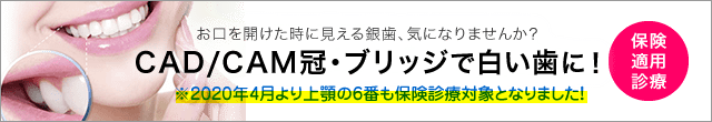 保険で銀歯ではなく白い歯へ