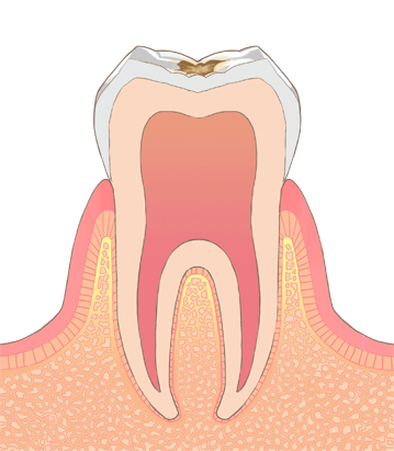 初期虫歯