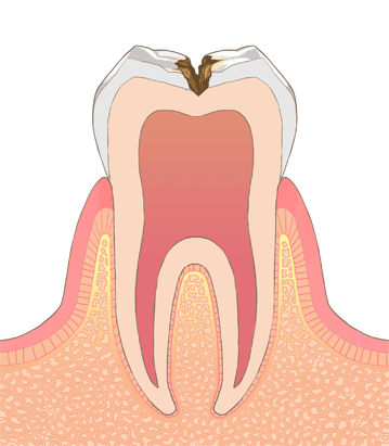 中期虫歯