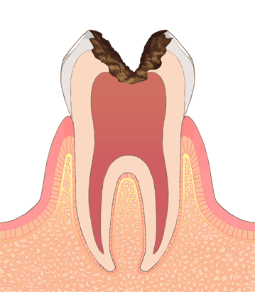 後期虫歯
