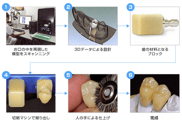 CAD/CAM冠ができるまで