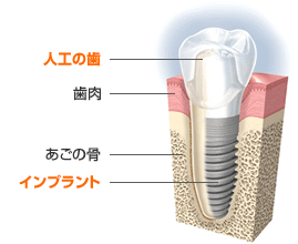 CTスキャンとインプラント治療