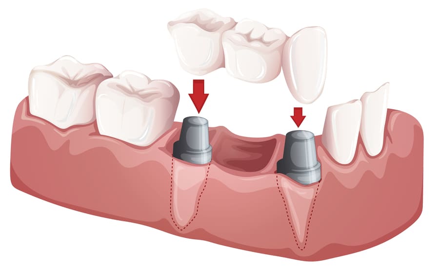 インプラント用義歯