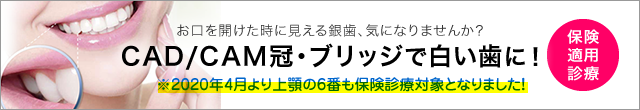 保険で銀歯ではなく白い歯へ