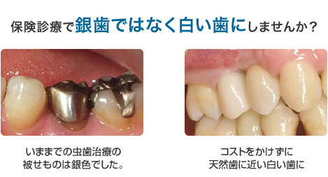 cadcam 冠 おすすめ しない