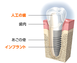 インプラント治療