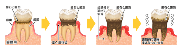 歯周病が進行していくイメージ