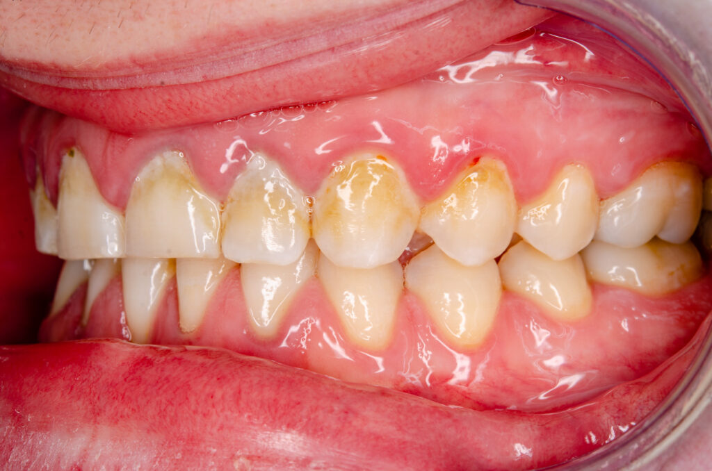 歯周病の原因のプラークのついた歯