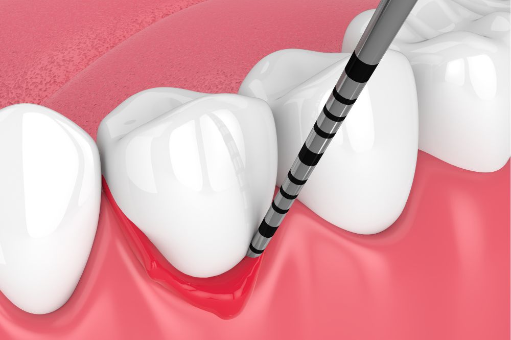 重度の歯周病の治療法