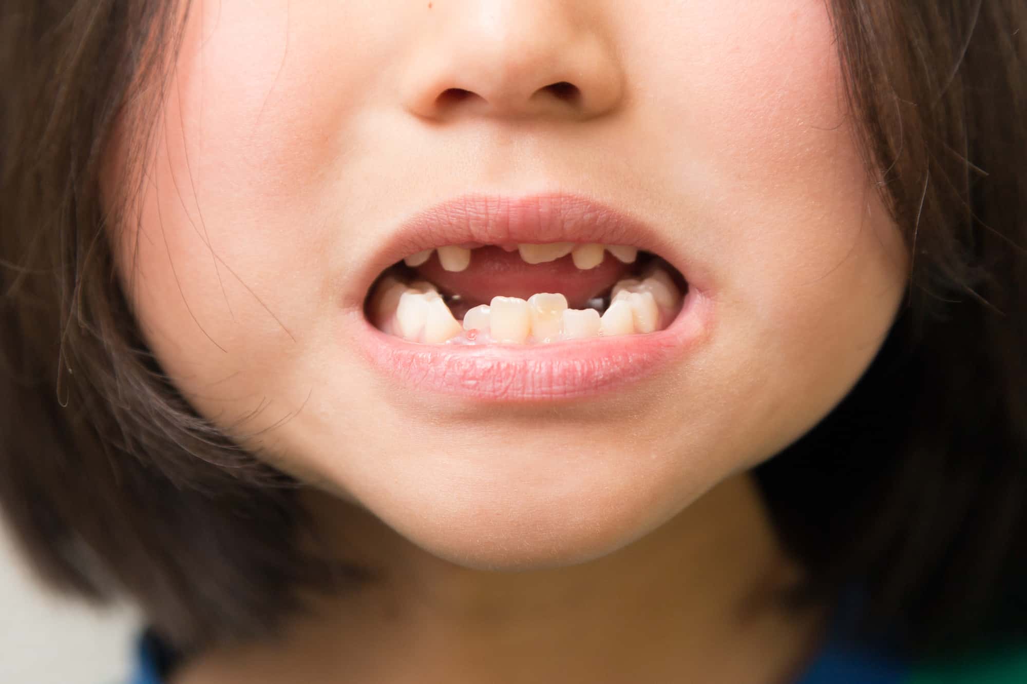 治したほうが良い悪い歯並びの子ども