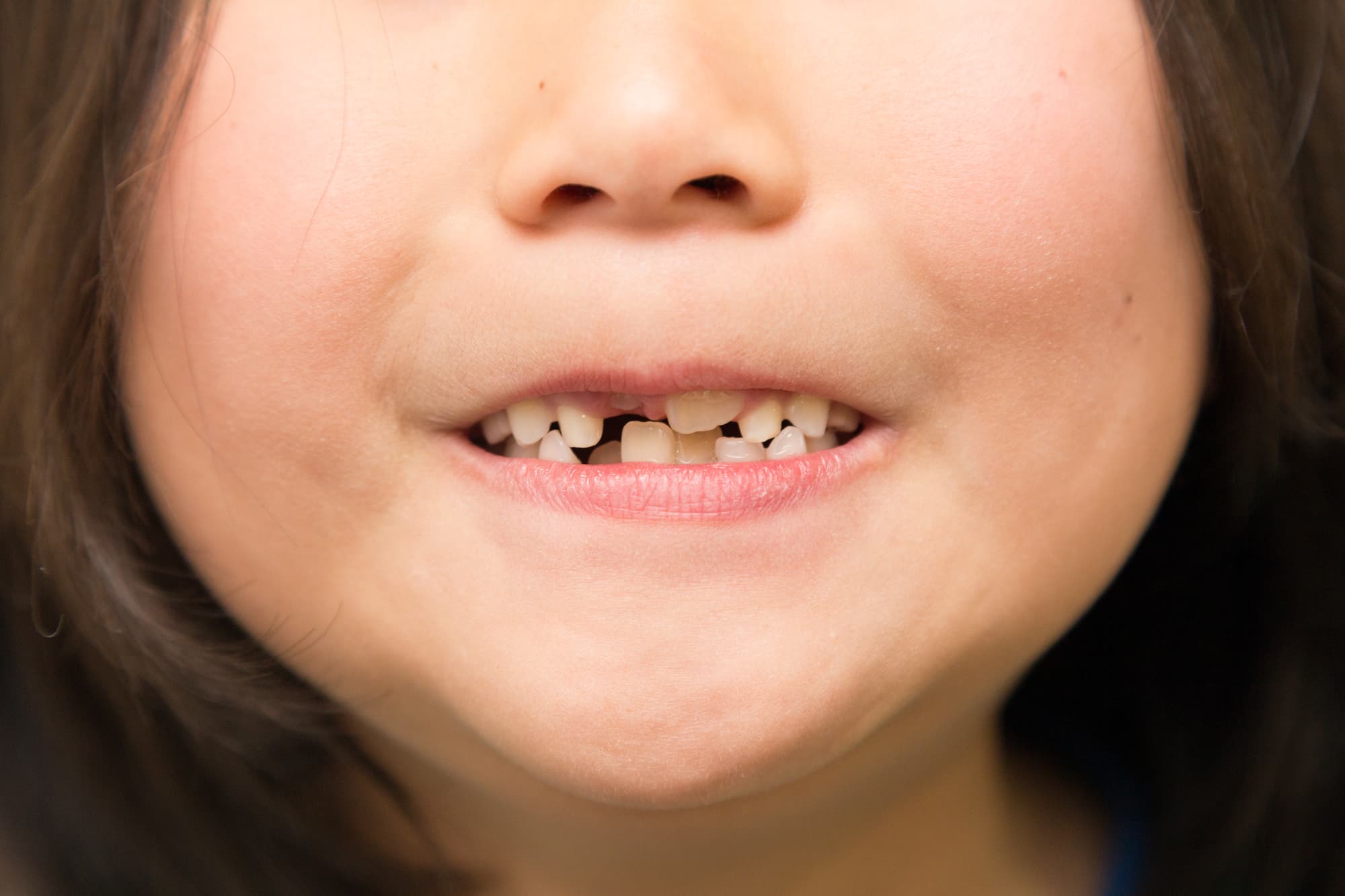 重度の歯列不正がある子ども