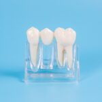 インプラントのイメージ模型