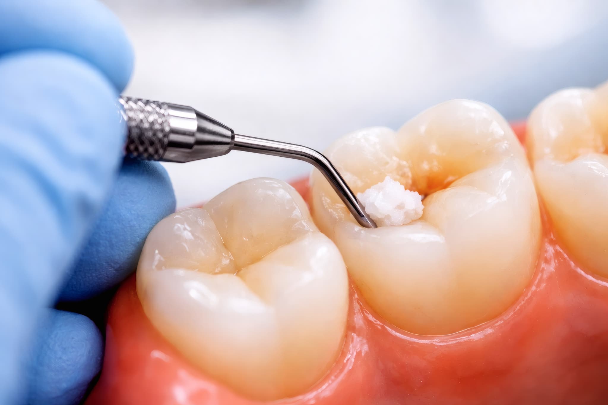 詰め物で虫歯を治療する様子