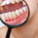 歯周病になった歯茎を虫眼鏡で見ているイメージ
