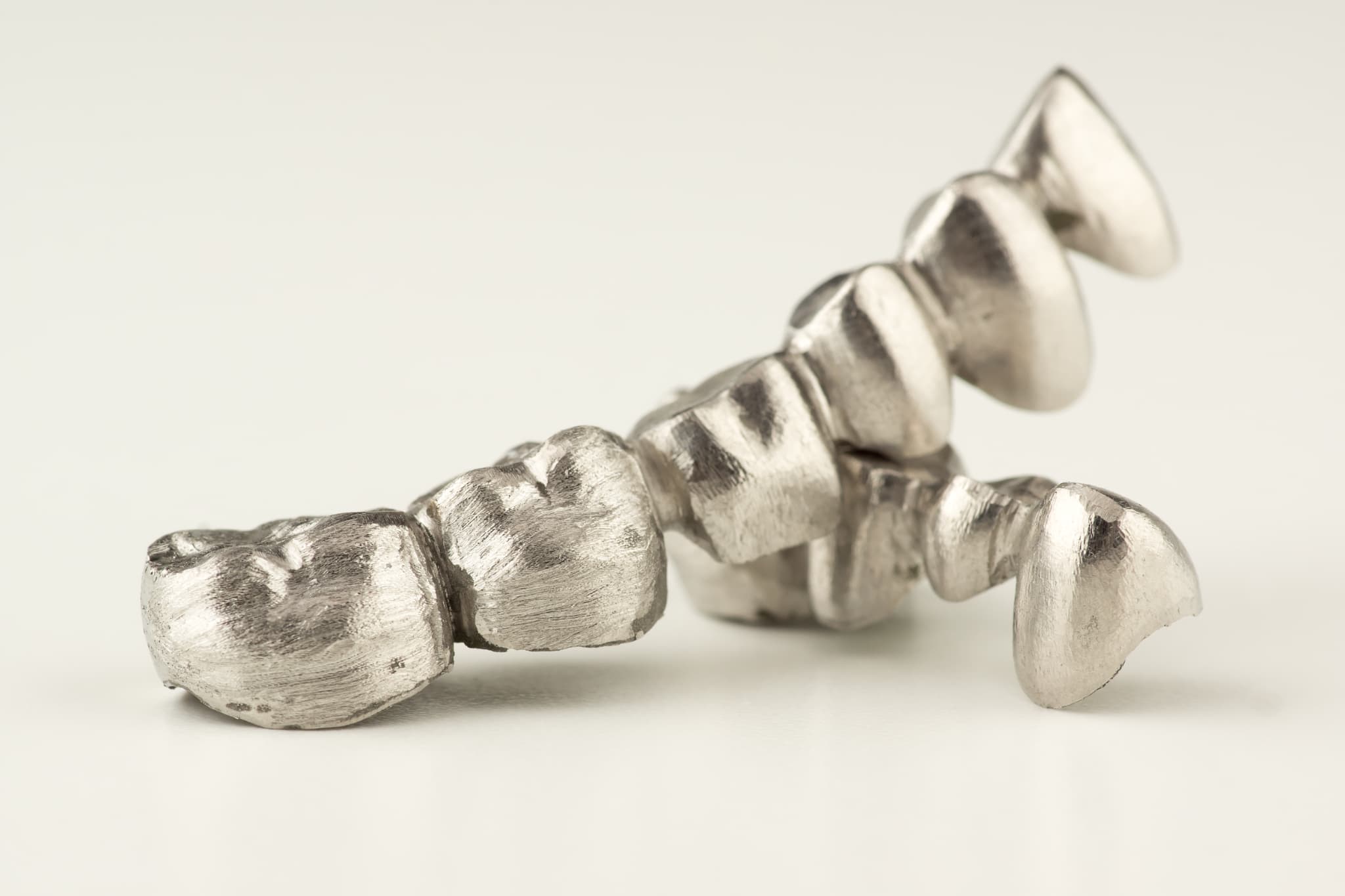 銀歯のブリッジ