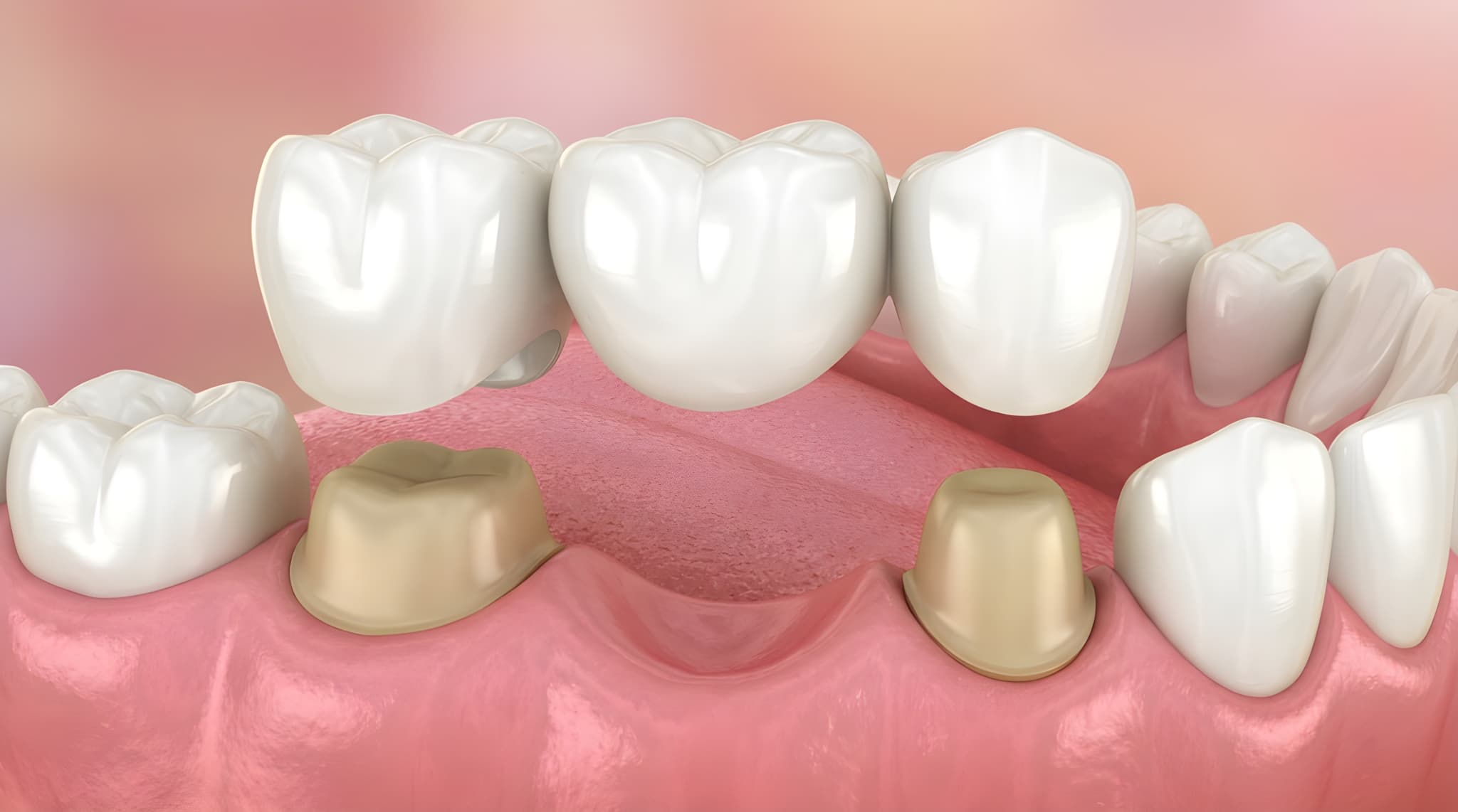 歯のブリッジ治療の様子