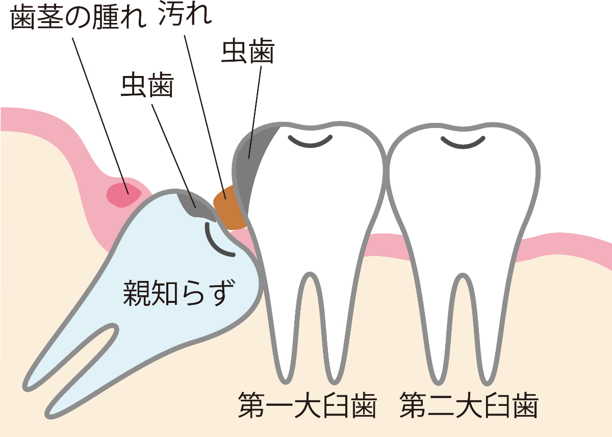 横向きに生える親知らずの解説