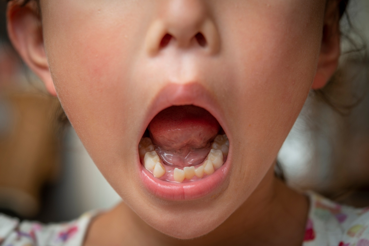 矯正を検討したほうがよい子どもの歯並び