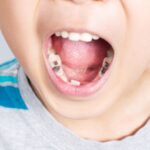 子どもの虫歯